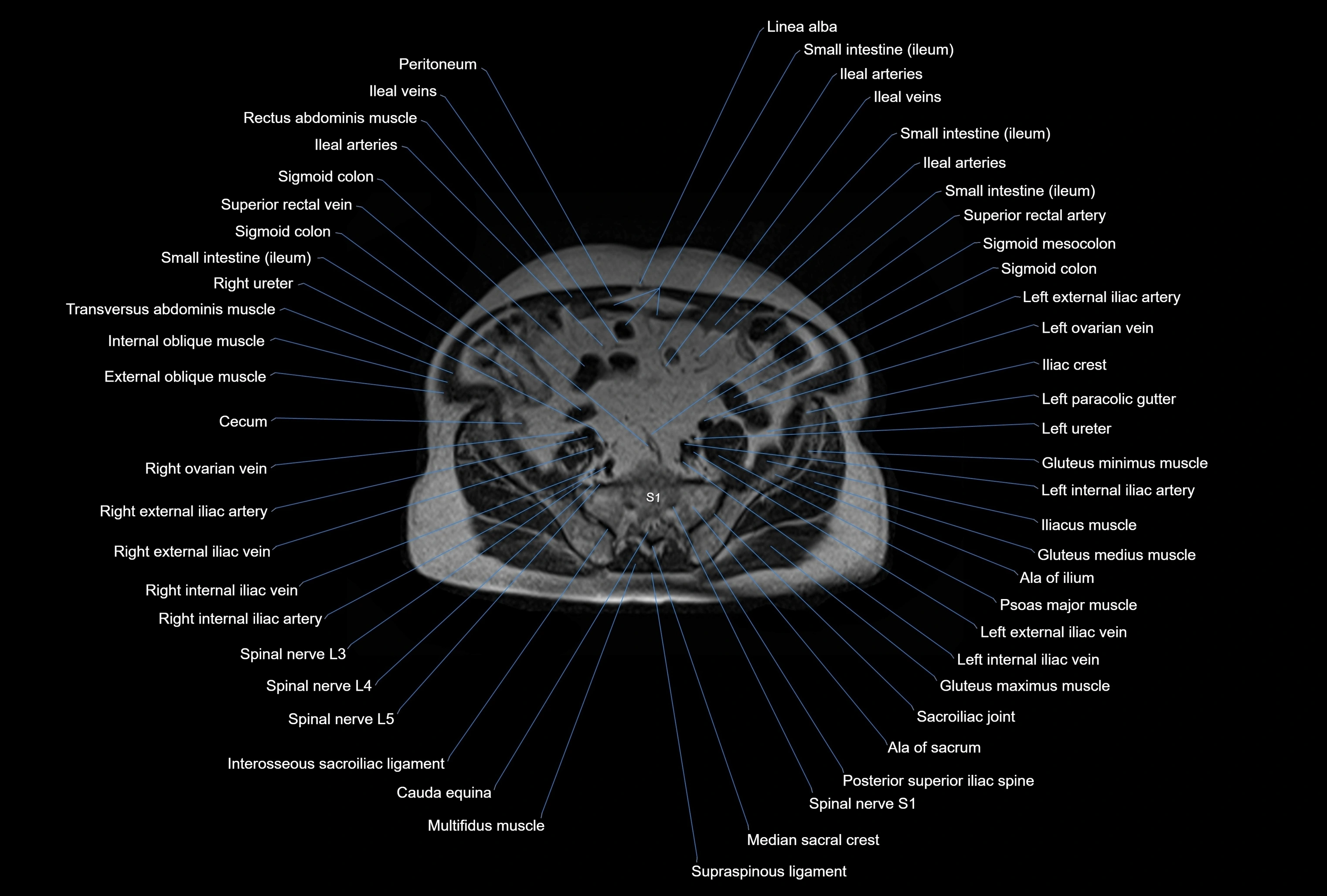 MRI Abdomen axial cross sectional anatomy radiology  image-img-00001-00041.webp